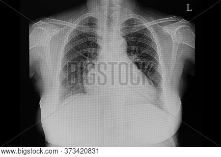 A Chest X-ray Film Of A Female Patient With Cardiomegaly And Pulmonary Edema.