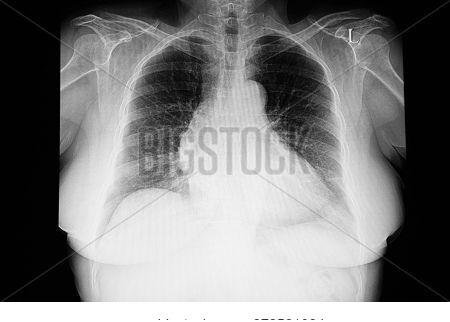 A Chest Xray Film Of A Patient With Cardiomegaly. Moderate Degree Of Congestion Is Noted.  Chest Rad
