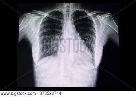 A Chest Xray Film Of A Patient With Cardiomegaly Or Enlarged Heart. A Case Of Abnormal X Ray.