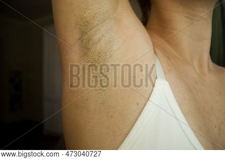 Hair On A Woman's Armpit. Concept Of Body Naturalness Self Love. Hair Removal.armpit Stubble.