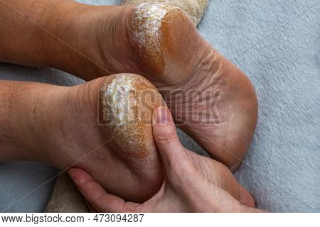 Heel With Dry Skin And Cracks. Medical Pedicure. An Orthopedic Doctor Applies A Healing Cream To The