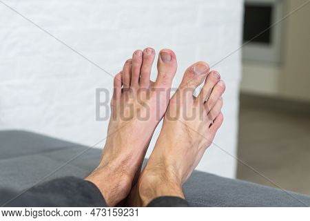 A White Man Holding His Toes, Showing What Looks Like A Rash With Red Blotchy Skin. A Common Side Ef