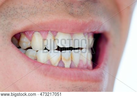 Tooth's A Man Smoking Bad. Man Smokes A Cigarettes Have Tooth Decay And Calculus On Teeth, So We Sho