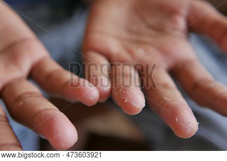 Close Up Of Dry Cracked Skin Of A Mens Hand