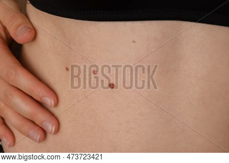 Unrecognizable Woman Showing Her Birthmarks On Skin Close Up Detail Of The Bare Skin Sun Exposure Ef