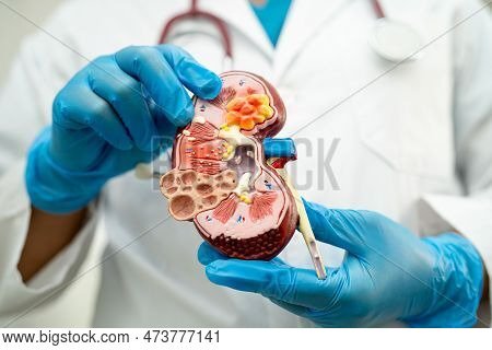 Kidney Disease, Chronic Kidney Disease Ckd, Doctor Hold Model To Study And Treat In Hospital.