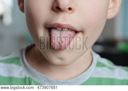 Kyiv, Ukraine - March, 01, 2023: White Spots On The Kid Tongue. Oral Thrush Is A Fungal Infection Th