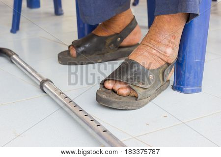 closeup feet of old asian man suffering from leprosy with a cane on the ground
