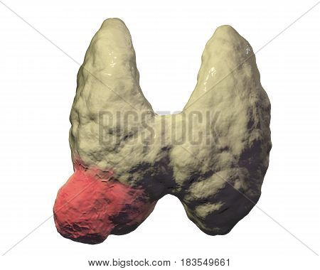 Thyroid cancer. 3D illustration showing thyroid gland with tumor isolated on white background