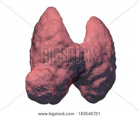 Thyroid cancer. 3D illustration showing thyroid gland with tumor isolated on white background