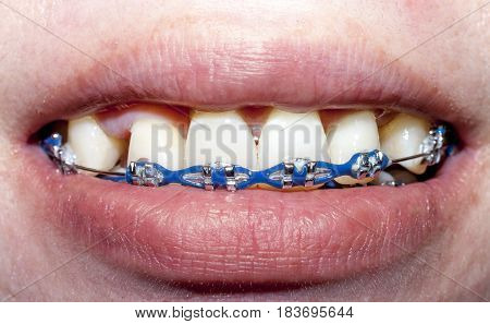 Bending to heal Dental health problems for women.