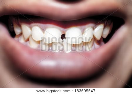 Teeth damaged other focus blue image for man.