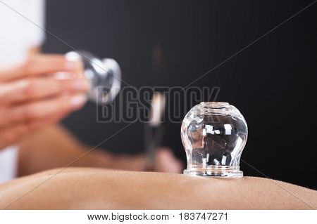 Close-up Of A Therapist Giving Cupping Treatment On Back