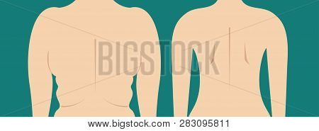 Folds Of Fat Back, Slim Female Body After Weight Loss, Correction Of Excess Weight, Liposuction Of  