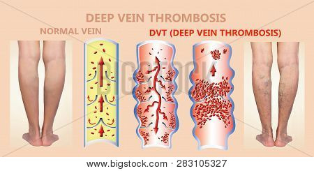 Deep Vein Thrombosis Or Blood Clots. Embolus. Structure Of Normal And Varicose Female Veins
