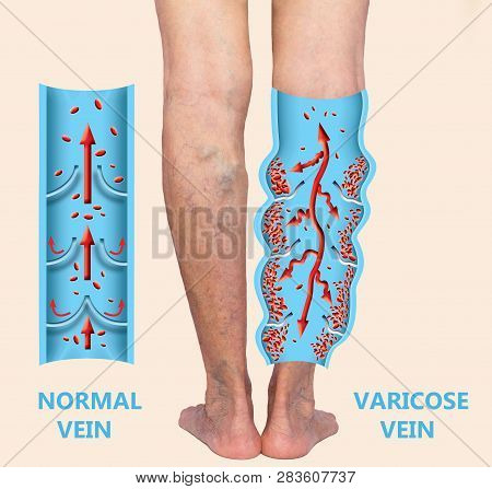 Varicose Veins On A Female Senior Legs. The Structure Of Normal And Varicose Veins. Concept Of Dry S
