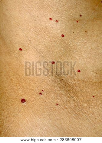 Angioma On The Skin. Red Moles On The Body. Many Birthmarks.