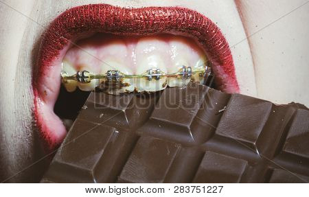 Braces On Chocolate Teeth. Food And Health. Young Female With Braces And Red Lips Eats Chocolate. Re