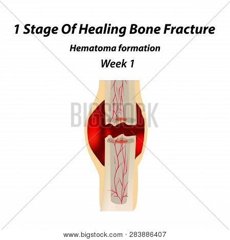 1 Stage Of Healing Bone Fracture. Formation Of Callus. The Bone Fracture. Infographics. Vector Illus