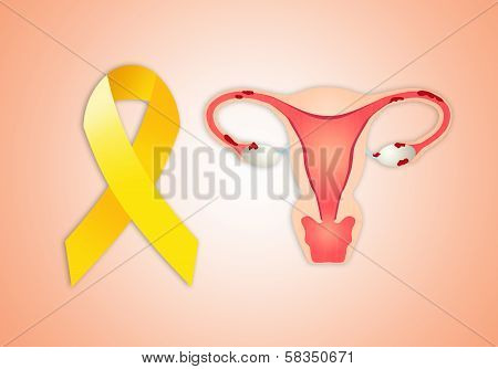 Endometriosis