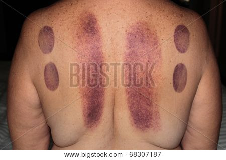 An unidentifiable person shows the bruising results after a session of Cupping Therapy. Cupping is an ancient form of Chinese alternative medicine, claimed to cure many ailments. Medical Healthcare 