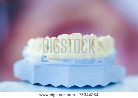 Dental Plaster Mold