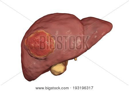 Liver cancer. 3D illustration showing presence of tumor inside liver isolated on white background