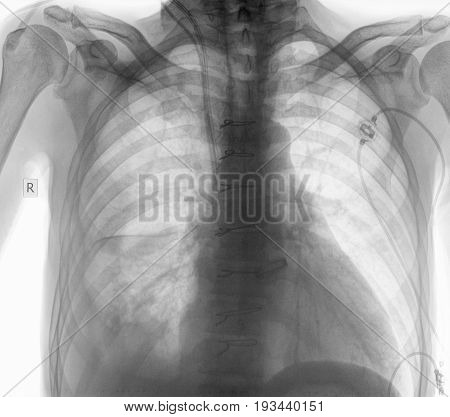 Radiogram of patient after surgical operation. Medical examination