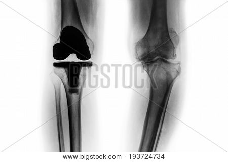 Film x-ray of osteoarthritis knee patient and artificial joint ( Total knee replacement ) . Isolated background .