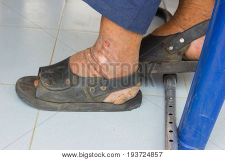 closeup feet of old asian man suffering from leprosy