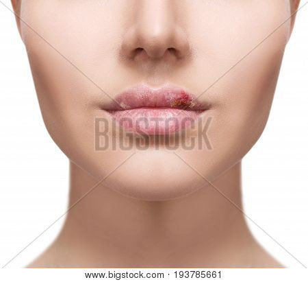 Plump female lips with herpes sore isolated on white.