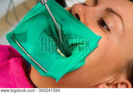Dentist Treats The Tooth With Modern Methods, Uses A Rubber Dam, Sterile Tooth Treatment.