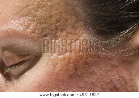 Acne scars