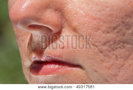 Pimple and acne scars