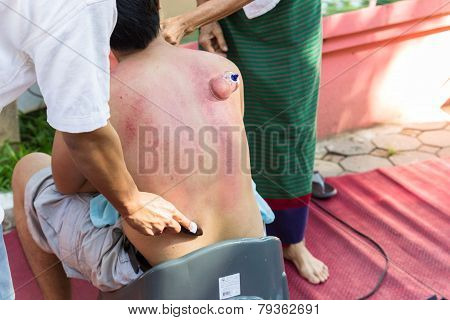 The Teacher Demonstrate Guasa And Skin Vacuum Technique Which Is The Alternative Medicine  For Skin