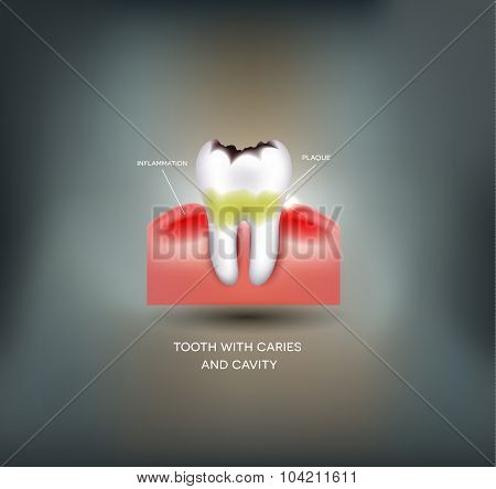 Dental Caries And Cavity