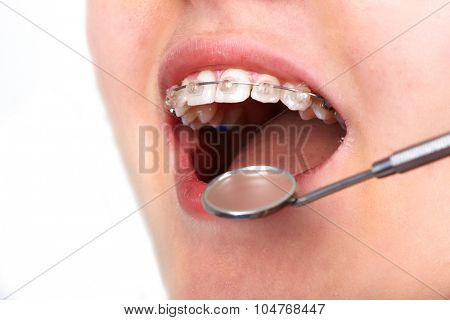 Teeth with orthodontic brackets. Dental health care.