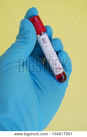 Systemic lupus erythematosus (SLE) positive