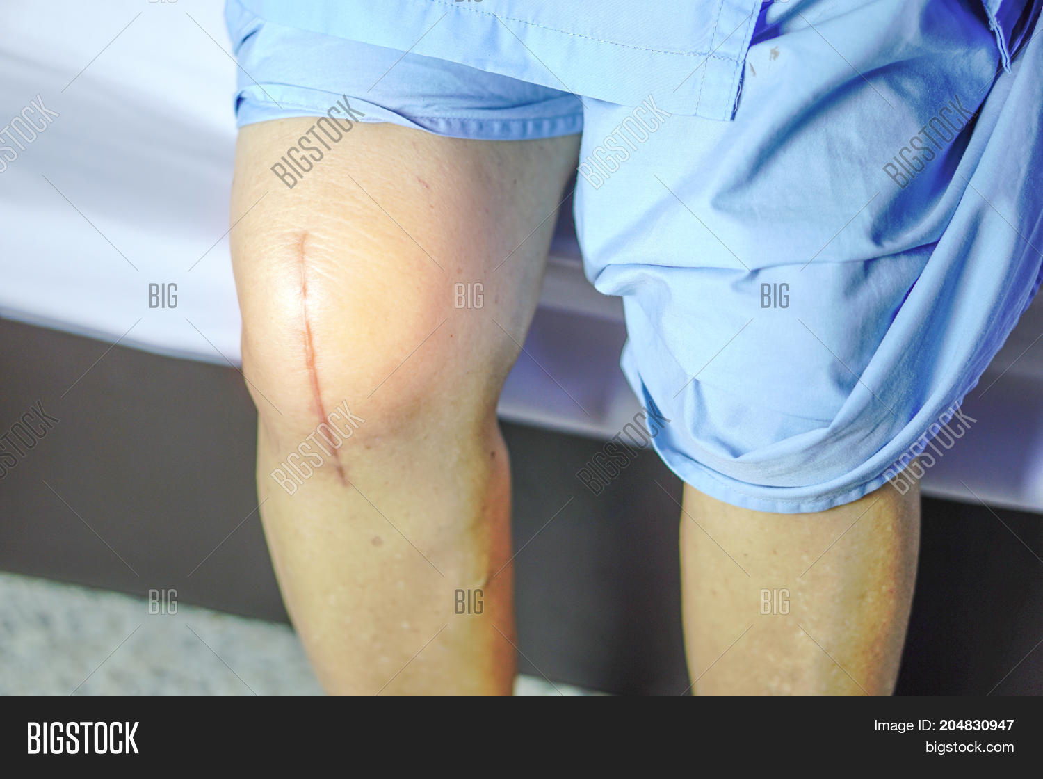 Scars Surgical Knee Image Photo Free Trial Bigstock