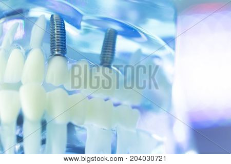 Dental Teeth Dentist Impant