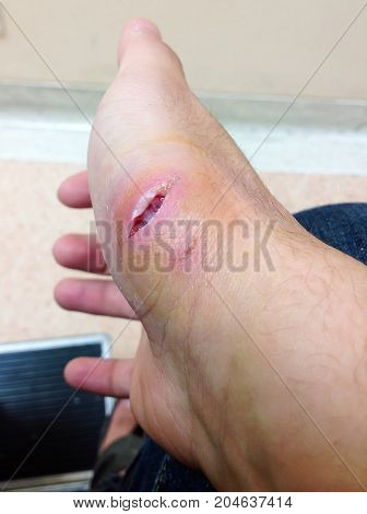 Dog bite fresh wound skin waithing for nurse and doctor treatment in hospital. Big hurt fresh puncture on hand was bitten by mad dog. patient in pain from injured scar from accident mad crazy pet.