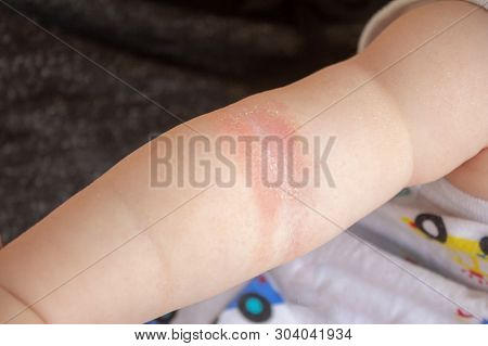 Close-up Of The Folds Of The Hand Of A Newborn Baby With Red Skin. Atopic Dermatitis Of Childrens Sk