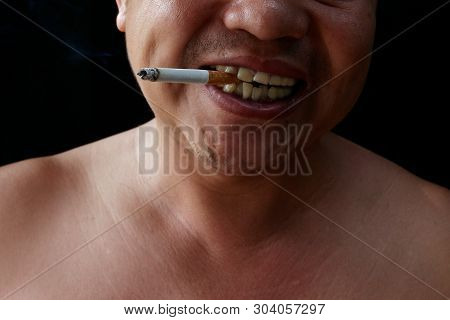 A Man Holding Cigarette. Nicotine Destroy Teeth And Gum Healthy. It Make Effect Yellow Stain, Tooth 