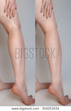 Varicose Veins Concept. Female Legs With Varicose Veins And Vasodilatation. Before And After