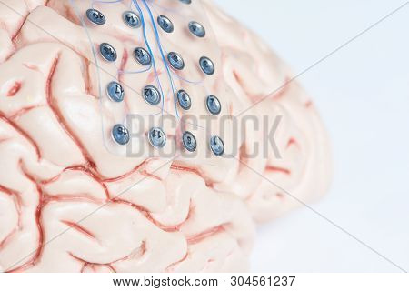 Close-up View Of Subdural Grid Electrode For Brain Waves Recording Or Electroencephalography On The 
