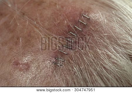 Medical Staples Close Up Scalp Incision Created While Extracting A Squamous Cell Carcinoma Using The