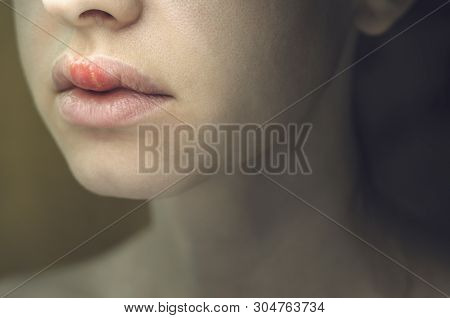 Herpes On The Upper Lip Of A Young Woman. Medical Background Of A Young Beautiful Girl With Herpes L