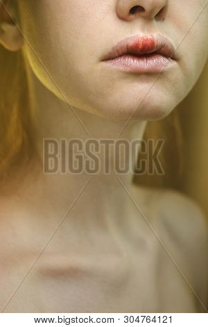 Herpes On The Upper Lip Of A Young Woman. Medical Background Of A Young Beautiful Girl With Herpes L