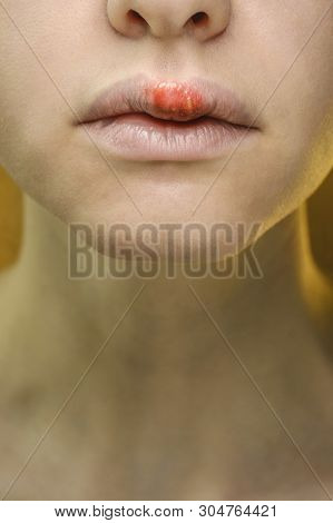 Herpes On The Upper Lip Of A Young Woman. Medical Background Of A Young Beautiful Girl With Herpes L