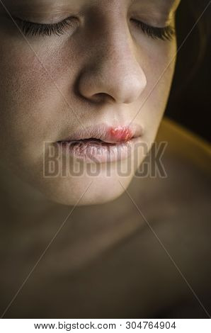 Herpes On The Upper Lip Of A Young Woman. Medical Background Of A Young Beautiful Girl With Herpes L